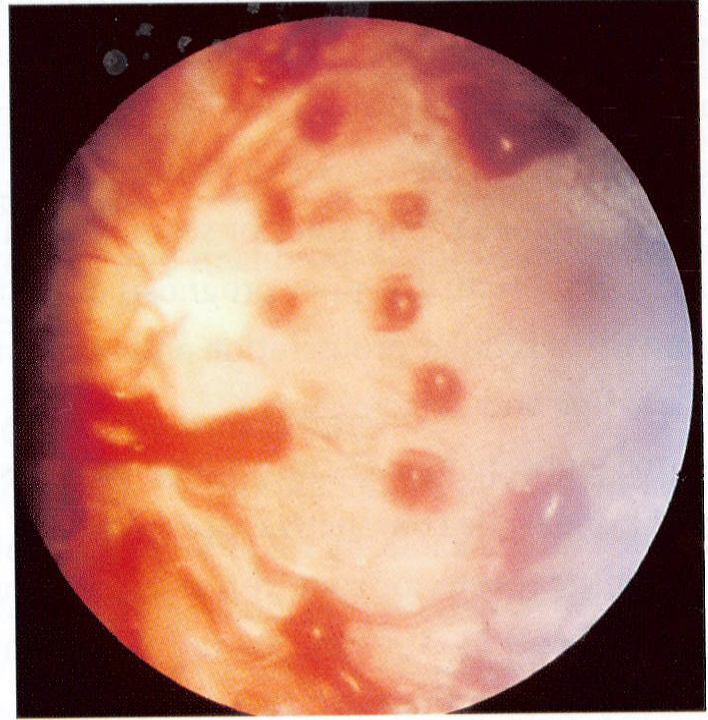 Multiple retinal haemorrhages secondary to trauma